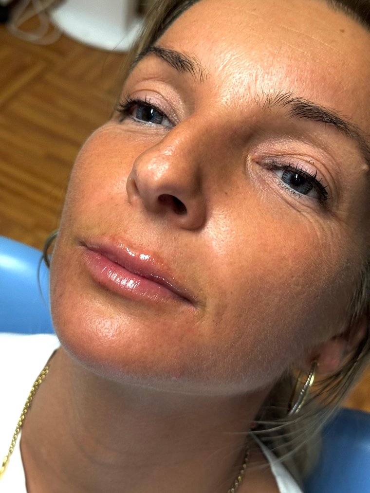 Labbra dopo il filler