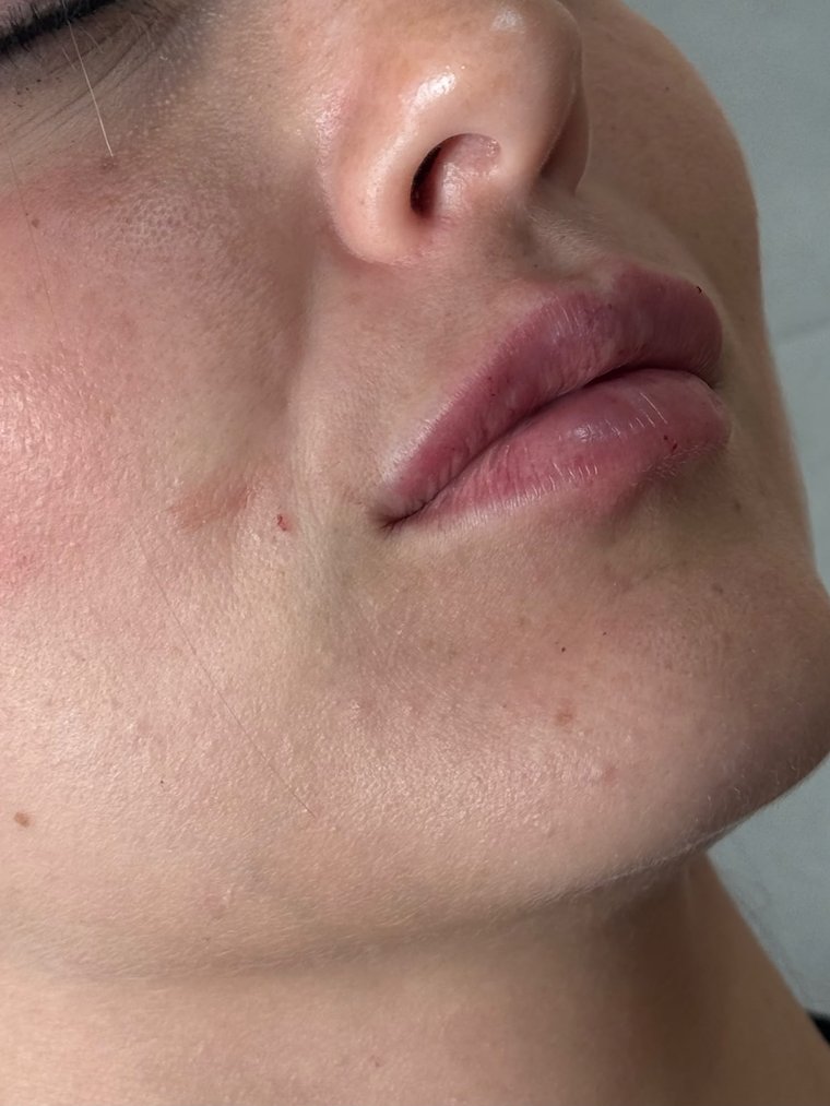 Labbra dopo il filler, secondo caso