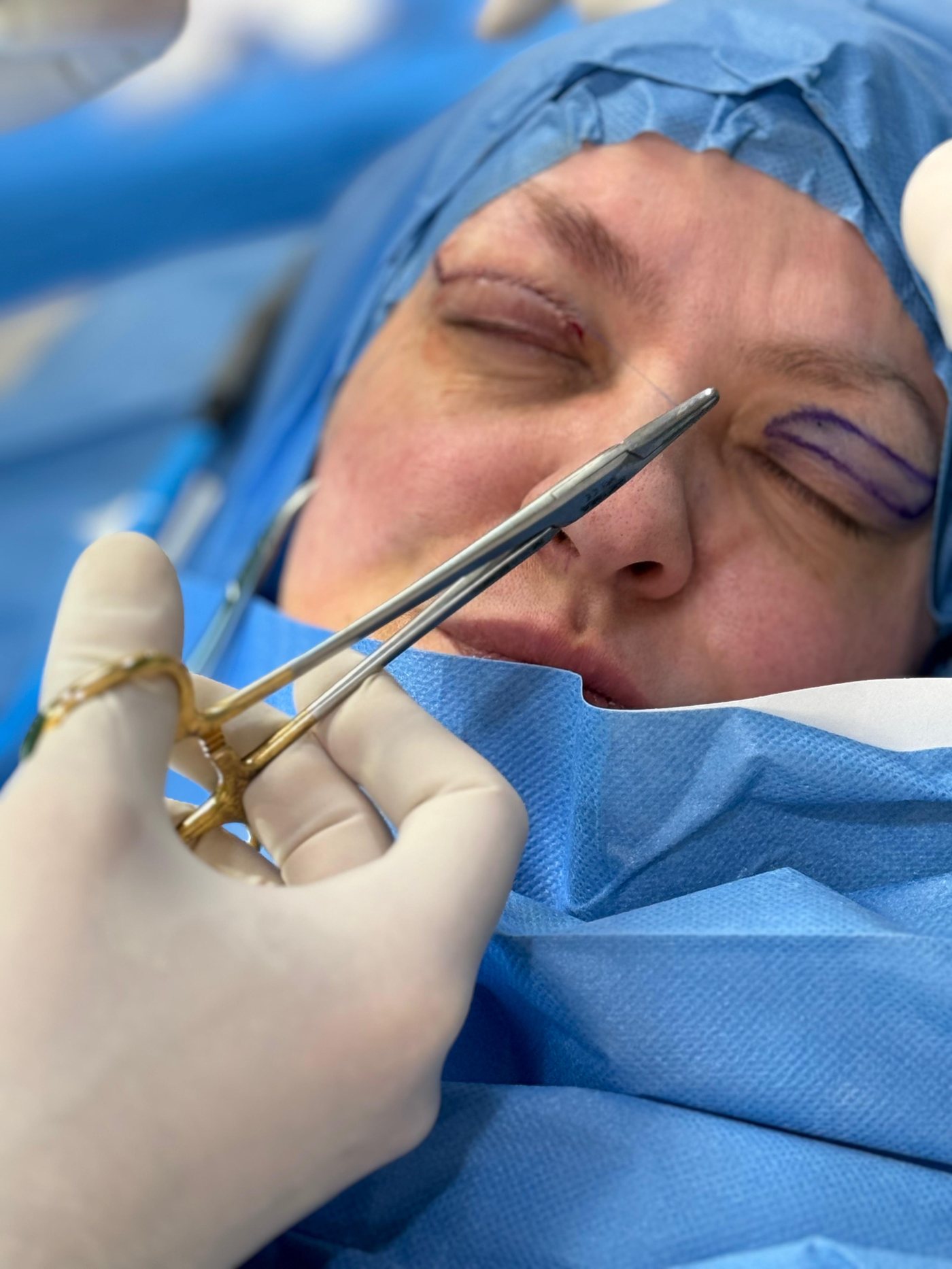 Marcatura preoperatoria della piega palpebrale