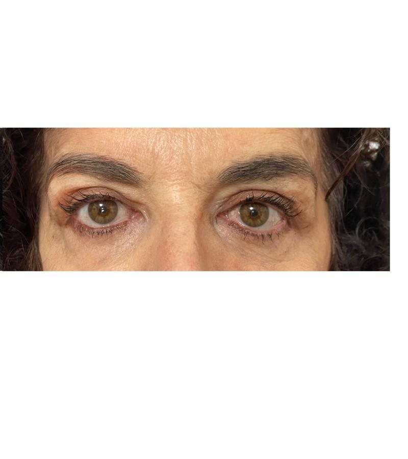 Occhi dopo la blefaroplastica, caso donna