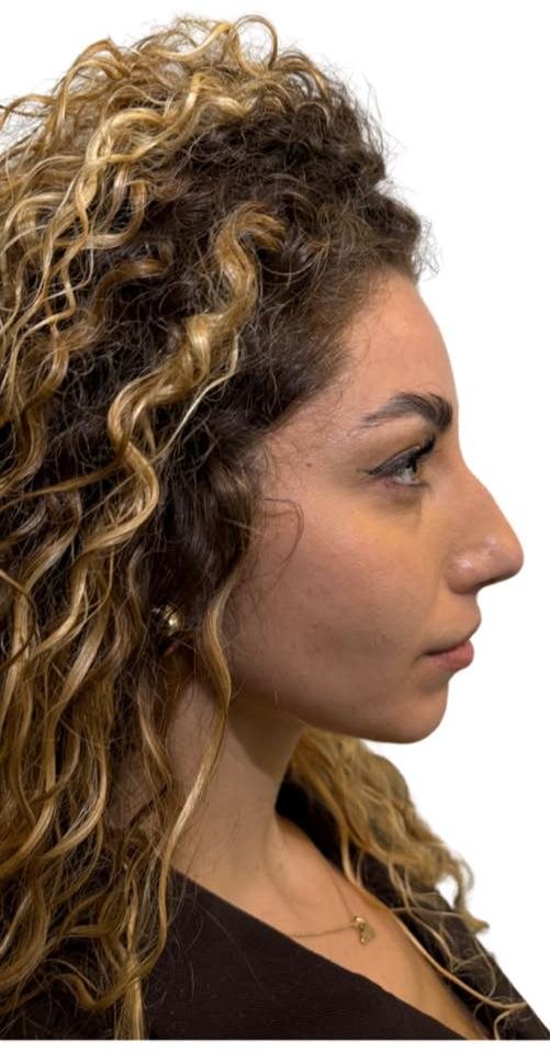 Profilo del naso prima del rinofiller, secondo caso
